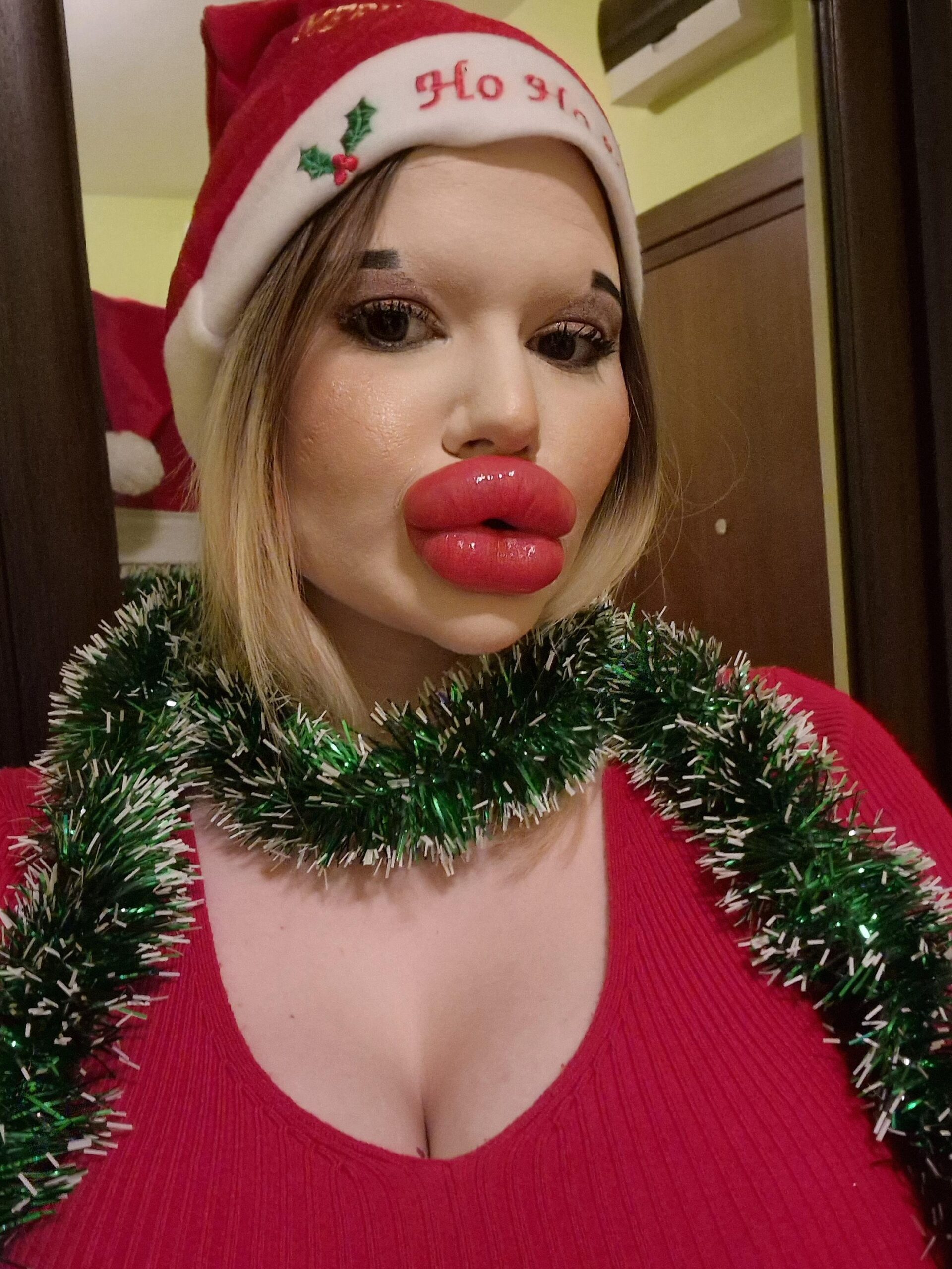 Woman With Worlds Biggest Lips Gets MORE Filler As Early Christmas