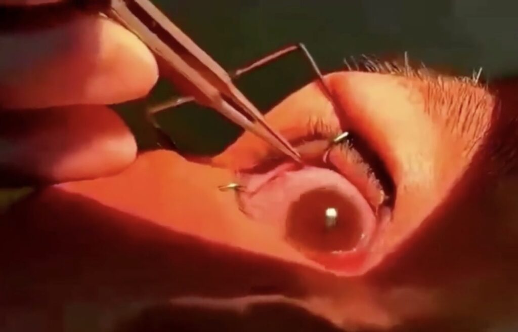 Video grab of the doctors removing the worms from a woman’s eyes.