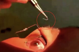 Video grab of the doctors removing the worms from a woman’s eyes.