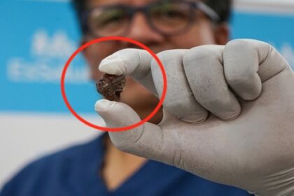 (Close up) The tiny rock stuck up a Elvira Medina’s nose for 33 years.