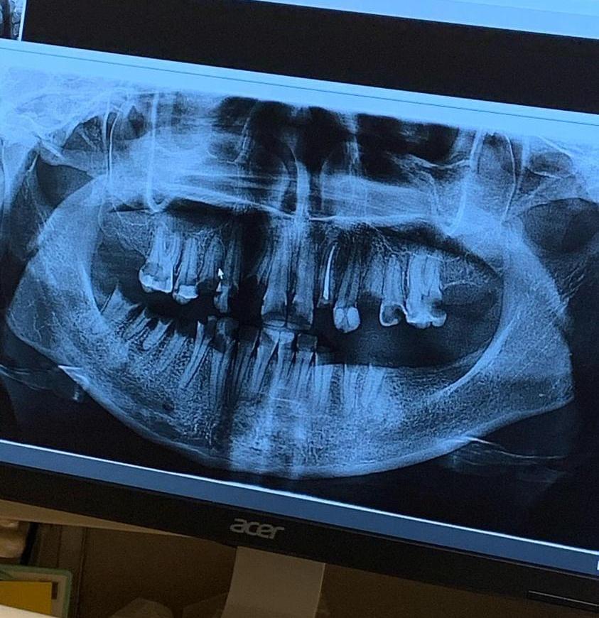 Faith’s natural teeth x ray, before the surgery.