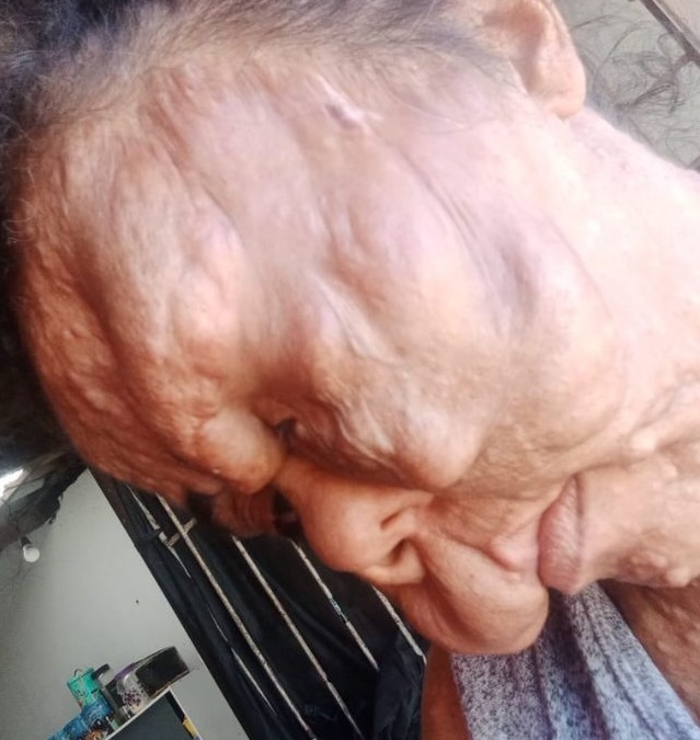 the mum from brazil suffering from rare facial deformity desperate for cosmetic surgery.