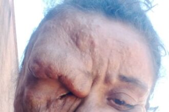 the mum from brazil suffering from rare facial deformity desperate for cosmetic surgery.