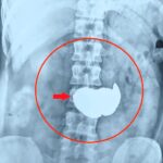 The x-ray of the man's abdomen who swallowed 63 coins in India.