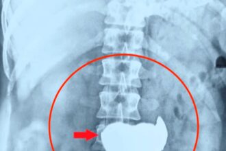 The x-ray of the man's abdomen who swallowed 63 coins in India.