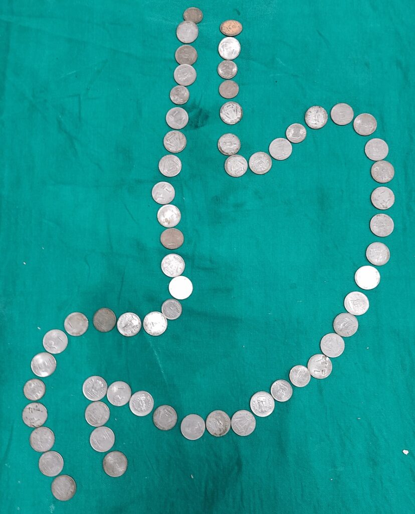 The extracted 63 coins from a man’s guts in India after surgery.