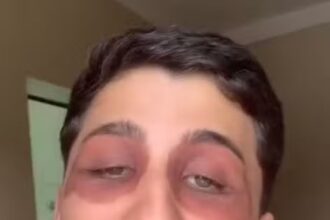 Gustavo wakes up baffled by mysterious black eyes, unsure of the cause. Painful swelling and discoloration leave him puzzled in Brazil.