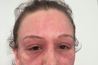 the young mom who finds an unexpected solution for her severe eczema with donkey milk after resorting to bleach baths, sharing her journey to relief.