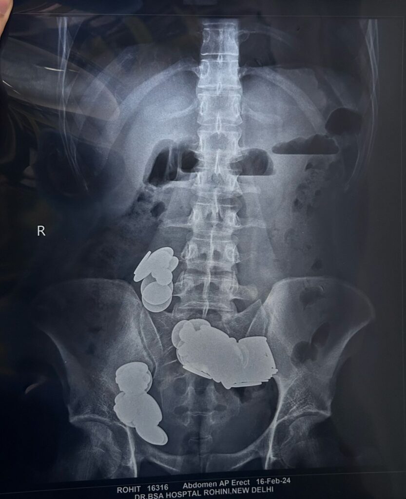 A 26-year-old wannabe bodybuilder in Delhi, India, swallowed 39 coins and 37 magnets in hopes that the zinc content would enhance his muscles. Hospitalized with severe pain and vomiting, surgeons successfully removed the objects, warning against such dangerous practices.