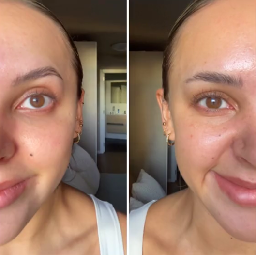 A woman shares her experience of looking "10 years older" after getting Botox in her masseter muscles, attributing the aging effects to the procedure, videos goes viral on social media.