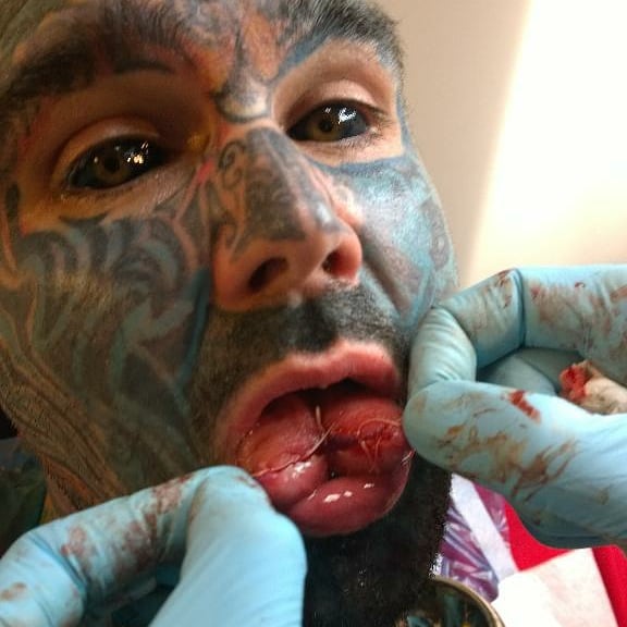 the ‘Britain’s Most Tattooed Man’ is now quitting ink to pay mortgage and has ‘risky’ implants removed due to health risk.