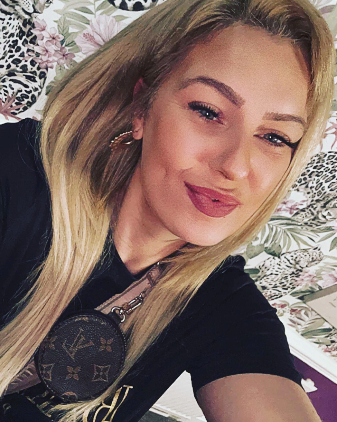 A woman shares her traumatic experience after undergoing breast reduction surgery in Turkey, leaving her with infections and permanent scarring.
