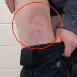 A man injured in a football match finds a bruise on his leg shaped like Prince Harry's face, complete with beard, hair, eyes, and nose.