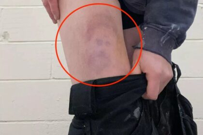 A man injured in a football match finds a bruise on his leg shaped like Prince Harry's face, complete with beard, hair, eyes, and nose.