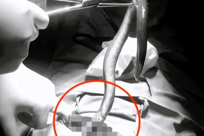 Stunned doctors remove a live 30cm eel from man's belly in Vietnam after severe abdominal pain. The eel entered through the anus, posing a rare medical mystery.