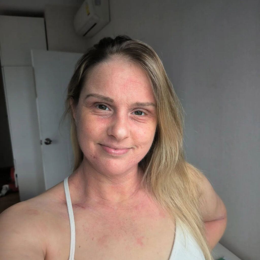 Woman shares her journey battling steroid cream "addiction" for eczema, urging awareness and caution in prescription, after enduring painful withdrawal.