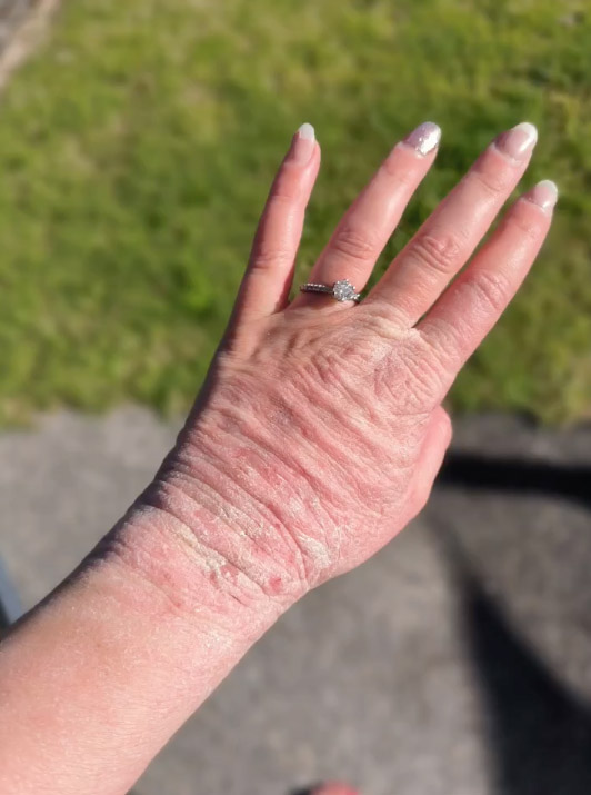 Woman shares her journey battling steroid cream "addiction" for eczema, urging awareness and caution in prescription, after enduring painful withdrawal.