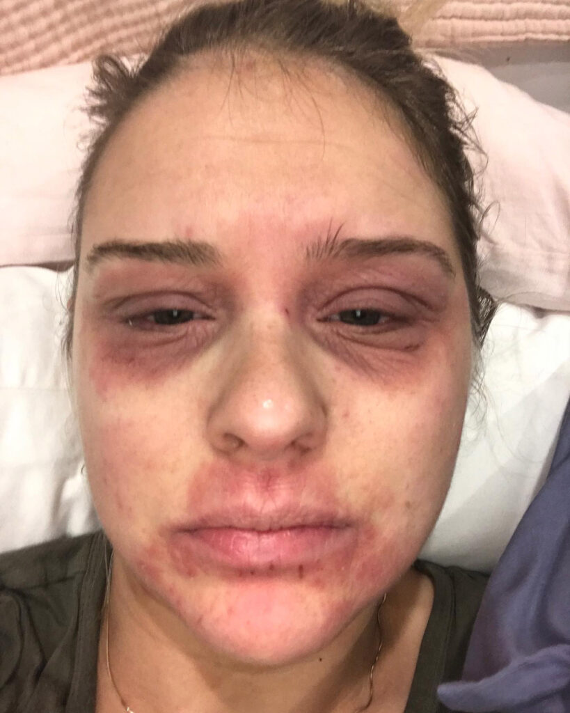 Woman shares her journey battling steroid cream "addiction" for eczema, urging awareness and caution in prescription, after enduring painful withdrawal.