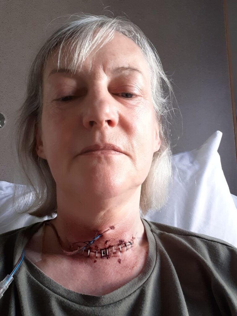 After spending £10,000 on surgery to remove an overactive thyroid, a woman faces the risk of losing her voice forever, but finds a silver lining in her singing ability.