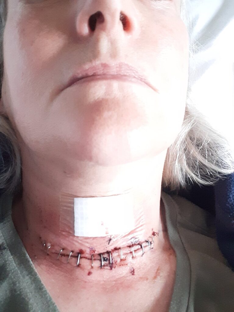 After spending £10,000 on surgery to remove an overactive thyroid, a woman faces the risk of losing her voice forever, but finds a silver lining in her singing ability.