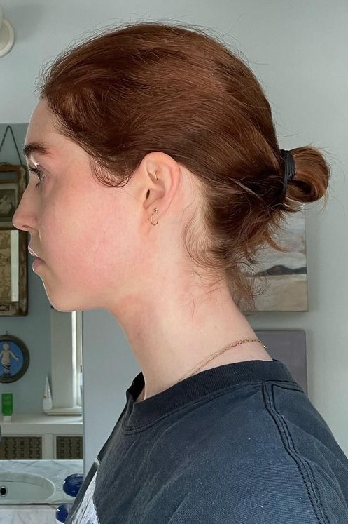 Mouth taping for jaw pain relief has gone viral, with claims of a slimmer face. Devon Kelly, 31, shares her experience and the controversial method's impact.