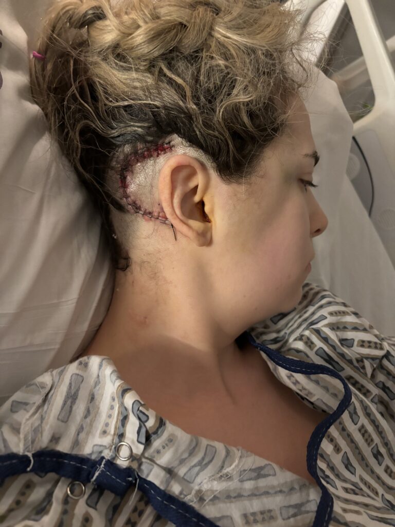 Facing Neurofibromatosis Type 2-related Schwannomatosis, Leanna Scaglione bravely shares her journey of surgeries and recovery, aiming for self-acceptance and resilience.