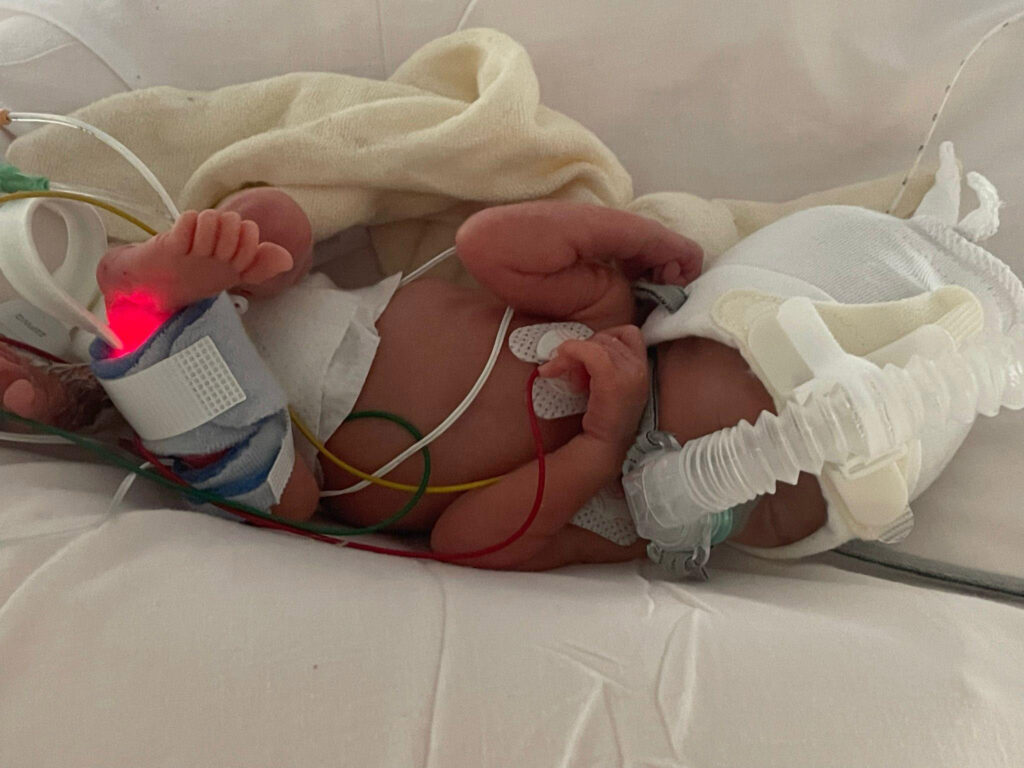 A tiny fighter, Nora, born weighing just 1lb 2oz, battles her rare condition with a contagious smile. Her parents share her feeding tube journey and resilience.