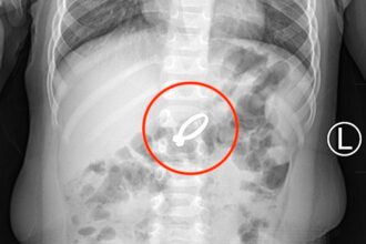 Toddler rushed to hospital in Qingdao, China, after swallowing her mother's diamond ring. Doctors successfully removed the ring via surgery.