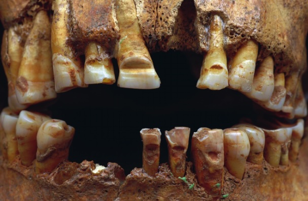 Ancient Vikings surprised researchers with their extensive body modifications, including filed teeth and skull deformations, unveiling a hidden facet of their culture.