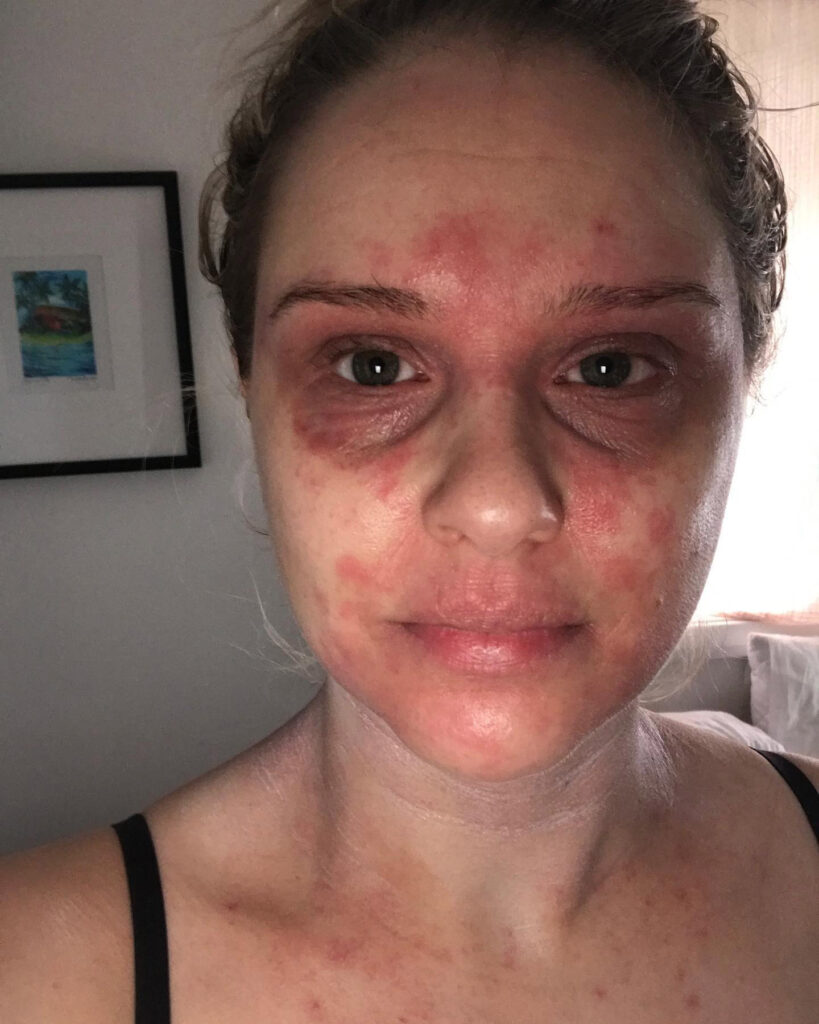Woman shares her journey battling steroid cream "addiction" for eczema, urging awareness and caution in prescription, after enduring painful withdrawal.