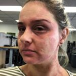 Woman shares her journey battling steroid cream "addiction" for eczema, urging awareness and caution in prescription, after enduring painful withdrawal.