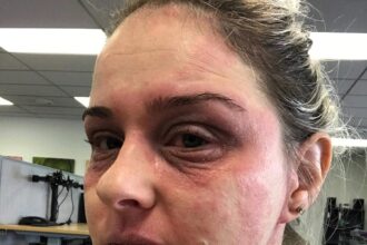 Woman shares her journey battling steroid cream "addiction" for eczema, urging awareness and caution in prescription, after enduring painful withdrawal.