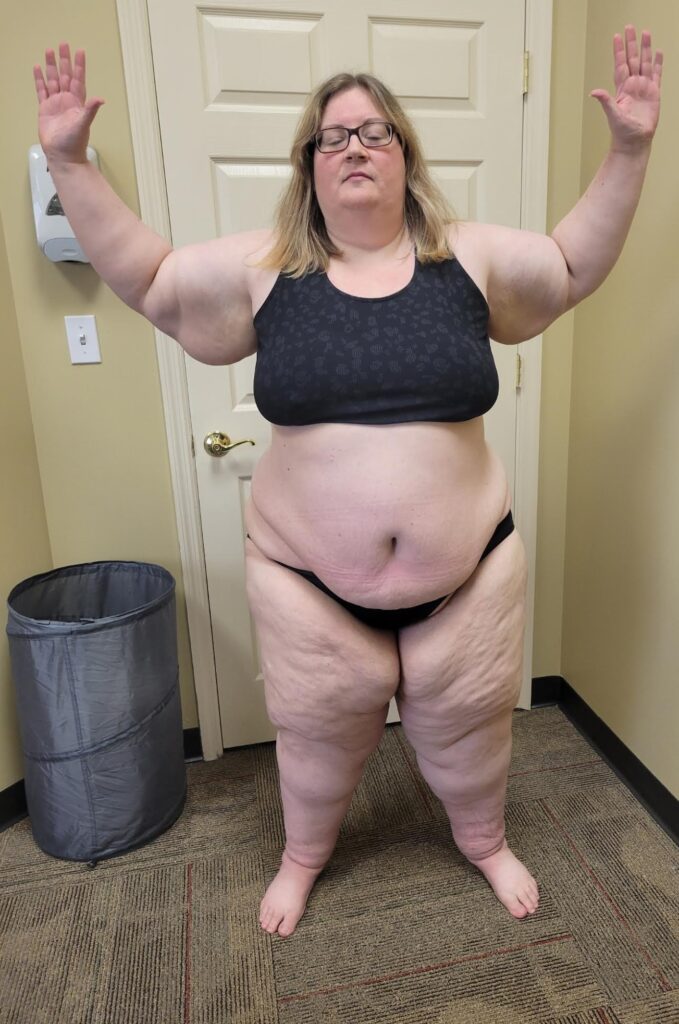 Shannon Ashley Nelson, 40, shares her lifelong battle with lipoedema, a condition causing her body to continually grow. Misunderstood as "fat" in childhood, Shannon’s condition led to immense pain and isolation.