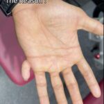 Karen Shetty, born with 12 fingers, showcases his 11th finger, a gym asset. Genetic rarity, it rotates 360°, aiding his unique grip strength.