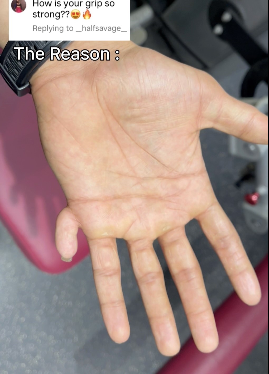 Karen Shetty, born with 12 fingers, showcases his 11th finger, a gym asset. Genetic rarity, it rotates 360°, aiding his unique grip strength.