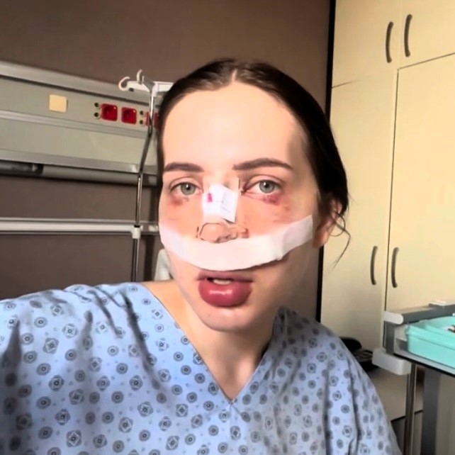 Influencer Bianca Comănici endured 33 hours of agony after a nose job in a mouldy basement in Turkey. Despite painkillers, she faced severe pain and now questions future surgeries. Her mother supported her throughout the ordeal.