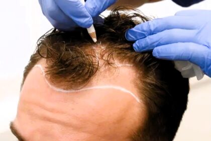 Beware of cheap hair transplant surgeries abroad, warns Dr. Matee Rajput, emphasizing safety and quality assurance in UK clinics.