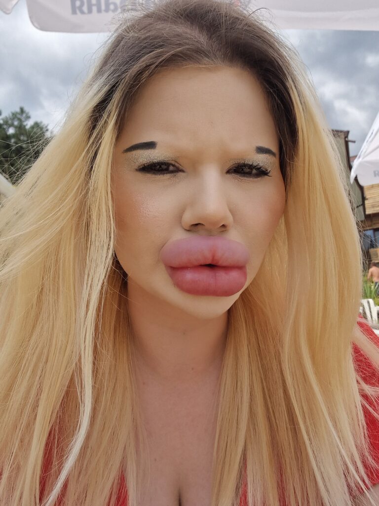 Andrea Ivanova, known for her "world's biggest lips," recently underwent another filler procedure, this time around her nose, aiming to balance her facial features. Despite initial concerns about safety, she remains committed to her extreme transformation, emphasizing the importance of hydration and caution post-procedure.