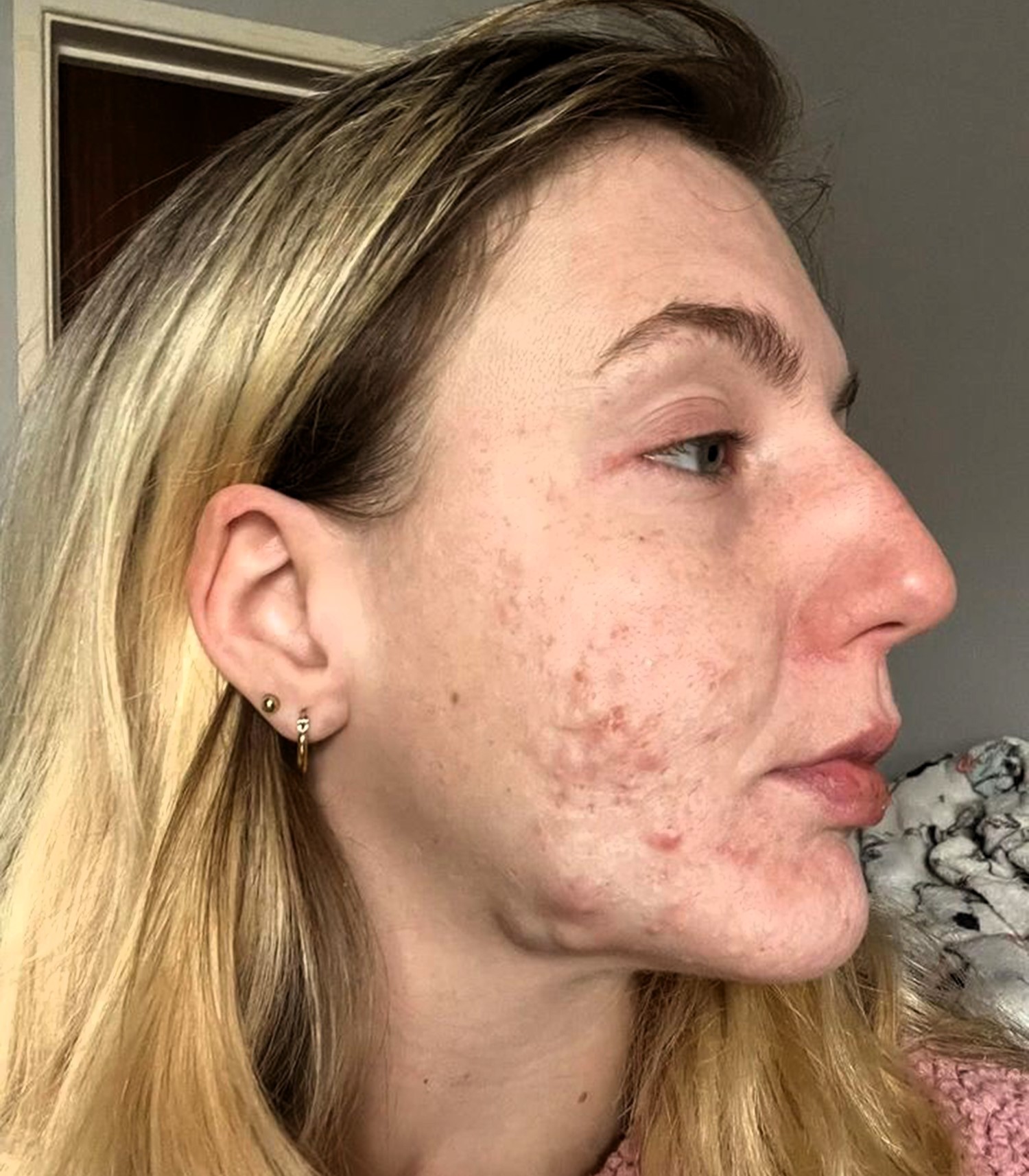 Ashlee Crumpton, from Wales, goes viral on TikTok sharing her severe Accutane side effects, including painful cysts and harsh online comments, in her fight against cystic acne.