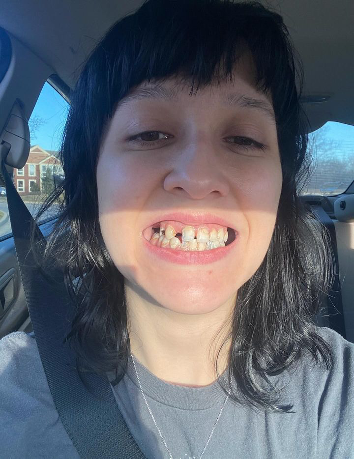 Courtney Luna, 29, wears dentures after a lifelong battle with tooth decay due to enamel deficiency. Despite surgeries and costs, she's now confident with her new smile.