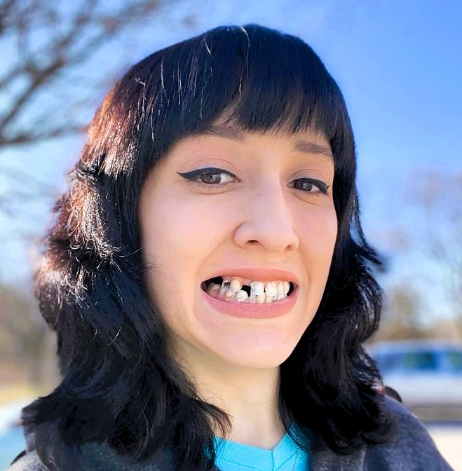 Courtney Luna, 29, wears dentures after a lifelong battle with tooth decay due to enamel deficiency. Despite surgeries and costs, she's now confident with her new smile.