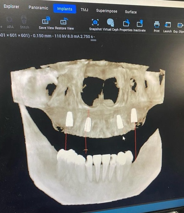 Courtney Luna, 29, wears dentures after a lifelong battle with tooth decay due to enamel deficiency. Despite surgeries and costs, she's now confident with her new smile.