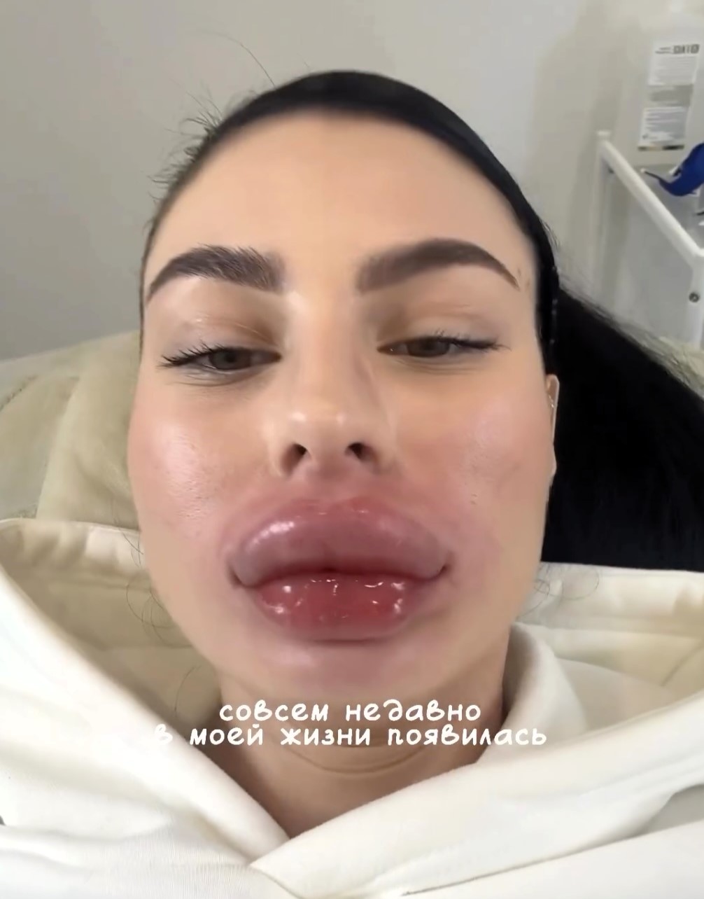 Influencer Sofia Bolshakova, 23, was left looking like Snoopy after a severe allergic reaction to lip filler removal. Thanks to quick action, she's now recovering and warning others.