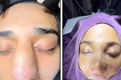 Dr. May's stunning rhinoplasty transformations go viral, showcasing dramatic before-and-after footage from his Este Hospital in Istanbul. Discover jaw-dropping results and client reactions!