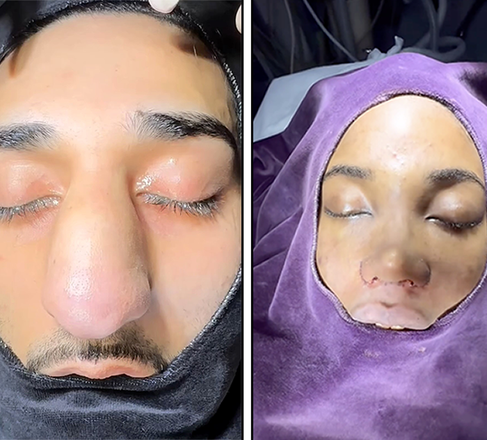 Dr. May's stunning rhinoplasty transformations go viral, showcasing dramatic before-and-after footage from his Este Hospital in Istanbul. Discover jaw-dropping results and client reactions!