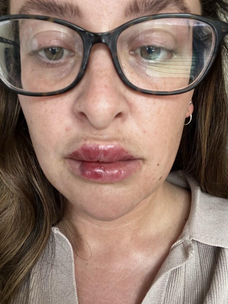 Woman's botched lip filler leaves her bruised and swollen. Katherine Tring shares her ordeal on TikTok, advising others to research practitioners to avoid similar issues.