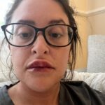 Woman's botched lip filler leaves her bruised and swollen. Katherine Tring shares her ordeal on TikTok, advising others to research practitioners to avoid similar issues.