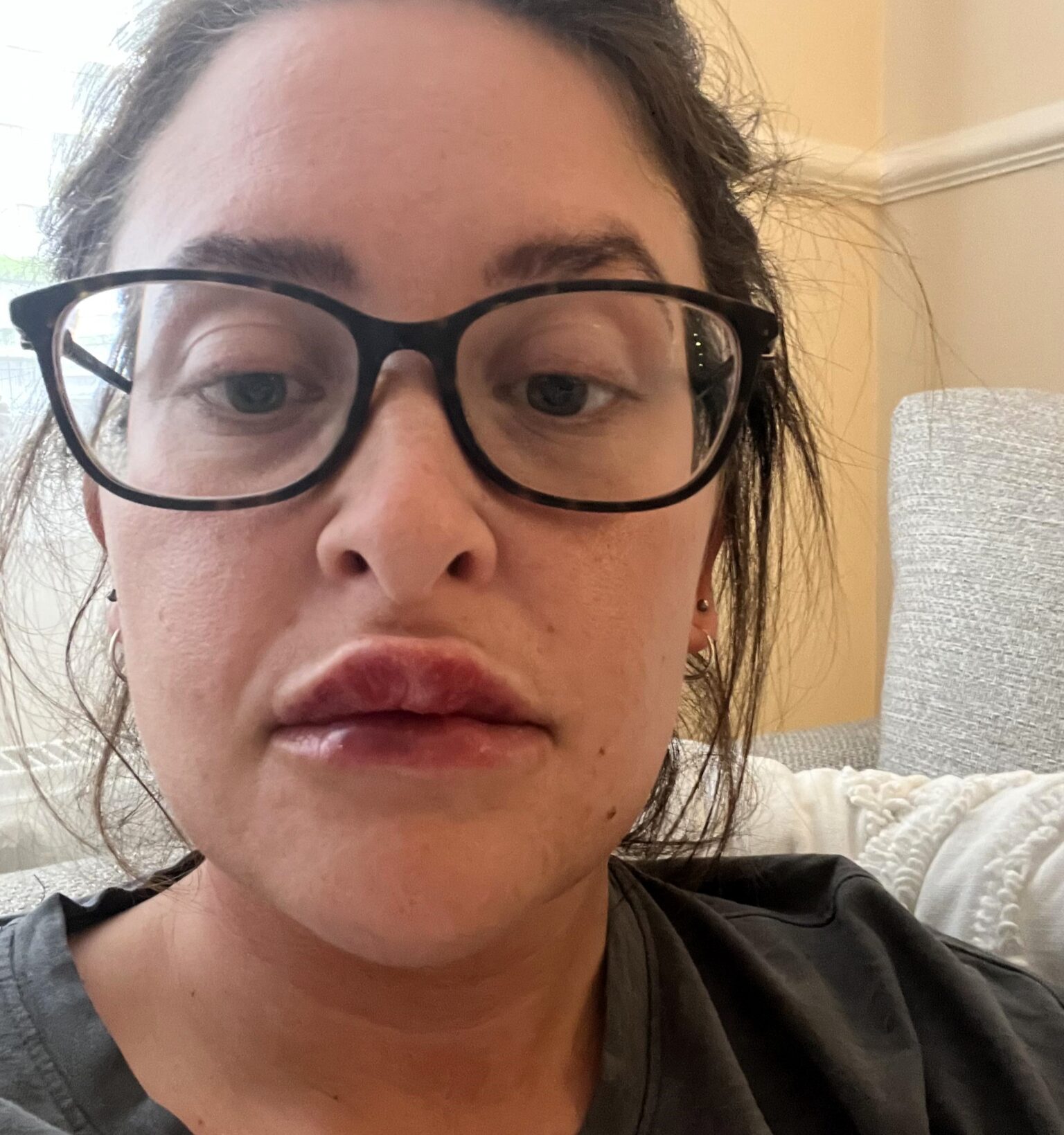 Woman's botched lip filler leaves her bruised and swollen. Katherine Tring shares her ordeal on TikTok, advising others to research practitioners to avoid similar issues.