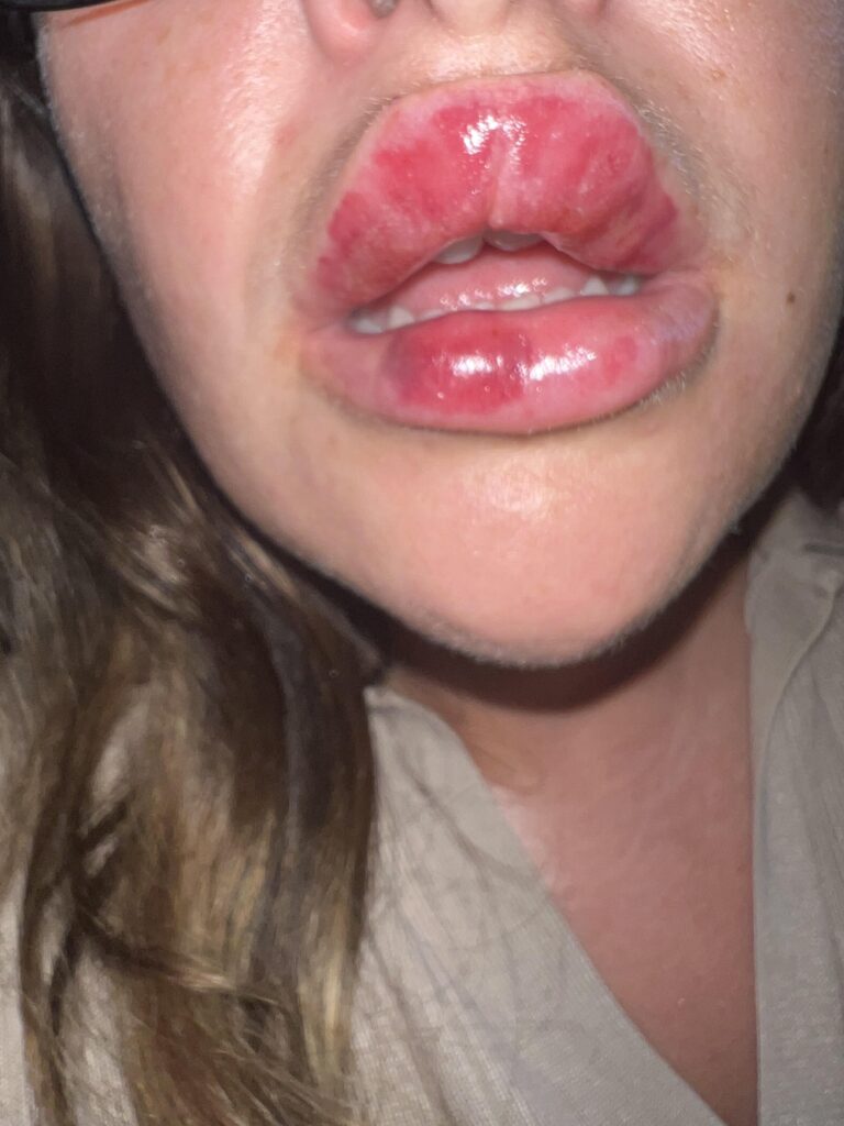 Woman's botched lip filler leaves her bruised and swollen. Katherine Tring shares her ordeal on TikTok, advising others to research practitioners to avoid similar issues.