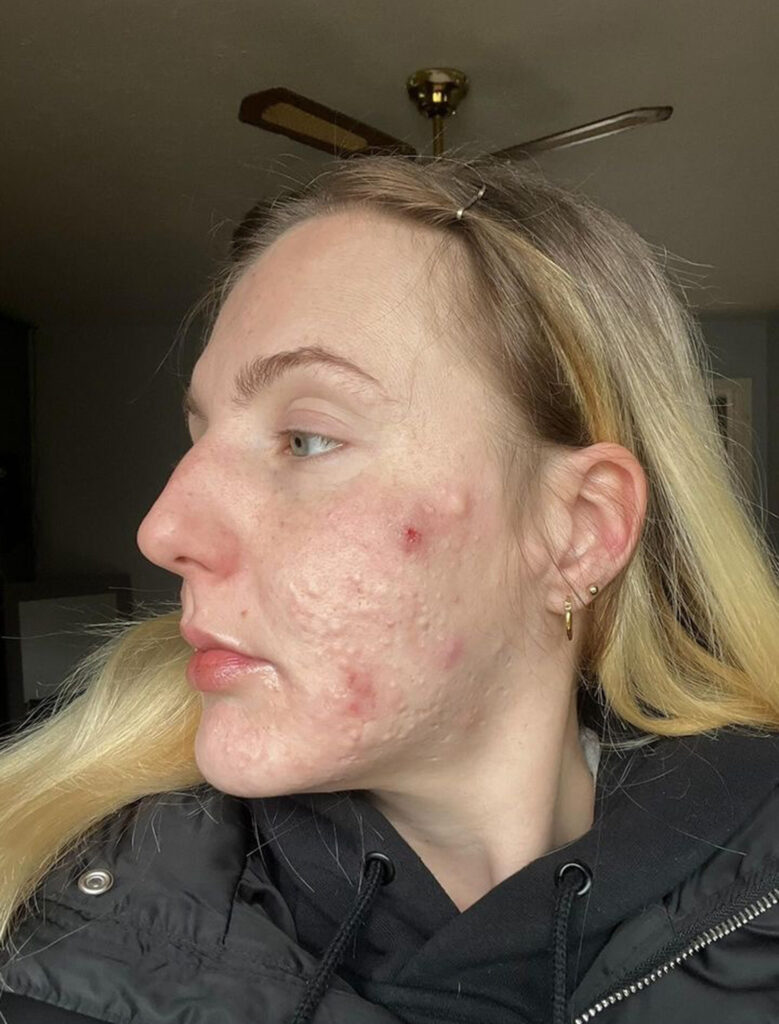 Ashlee Crumpton, from Wales, goes viral on TikTok sharing her severe Accutane side effects, including painful cysts and harsh online comments, in her fight against cystic acne.